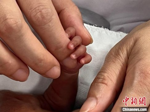 出生仅490克 广西一名“巴掌宝宝”被成功救治